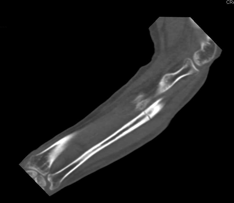 Ulnar Fracture Without Fusion Across the Fracture - CTisus CT Scan