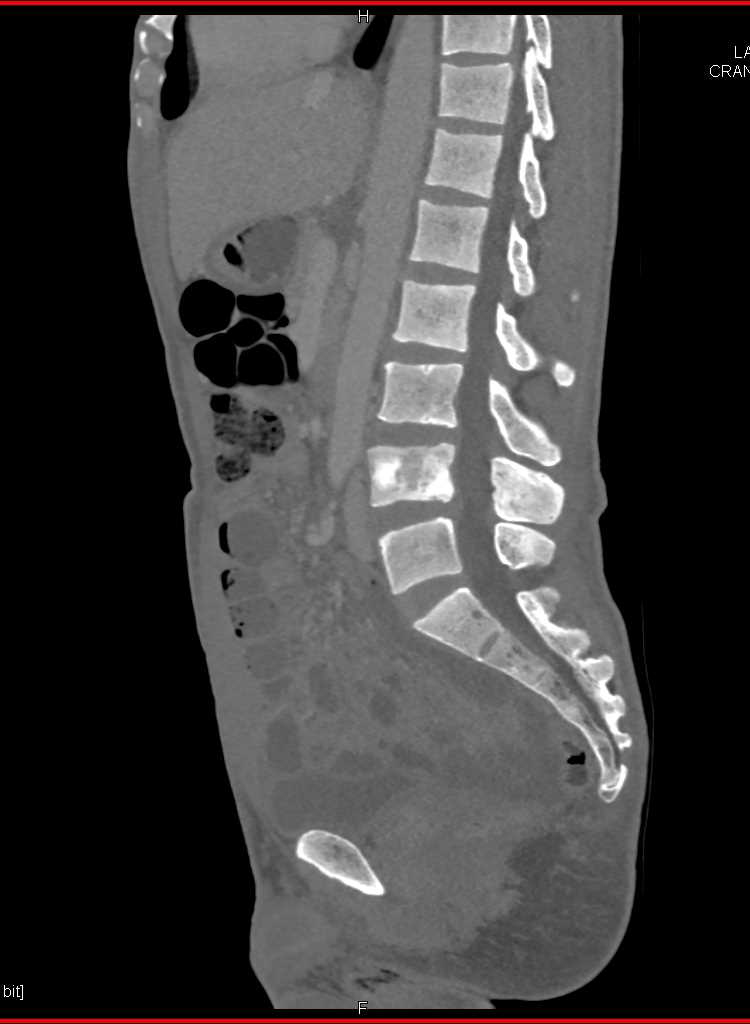 Carcinoid with Blastic Metastases - CTisus CT Scan