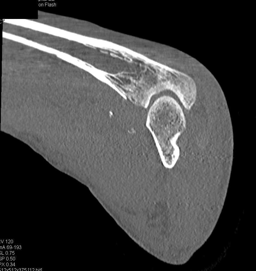 Ulnar Fracture and Pulmonary Embolism (PE) in Post Trauma Patient - CTisus CT Scan