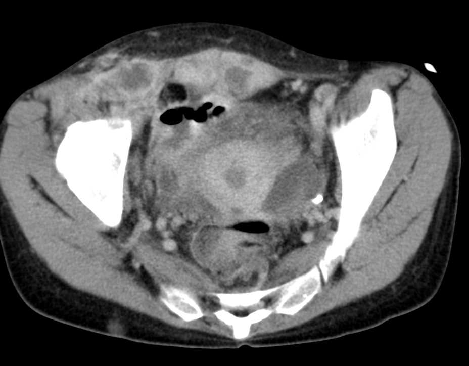 Desmoid Tumor Abdominal Wall - CTisus CT Scan