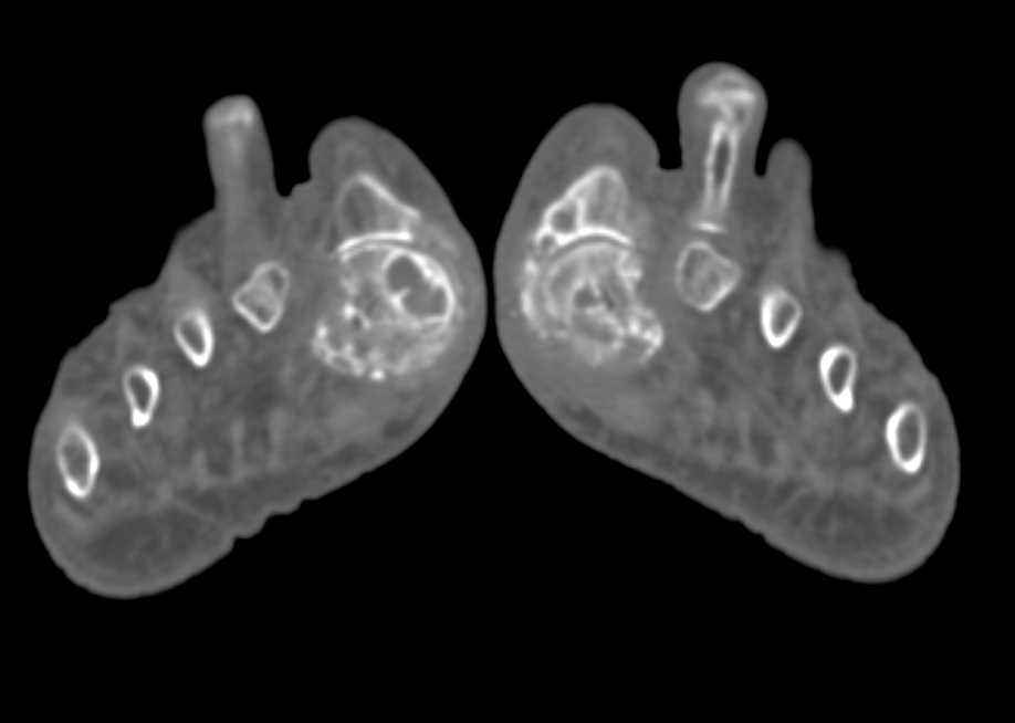 Gout with Multiple Large Tophi Especially in the First Metatarsal Phalangeal Joint - CTisus CT Scan