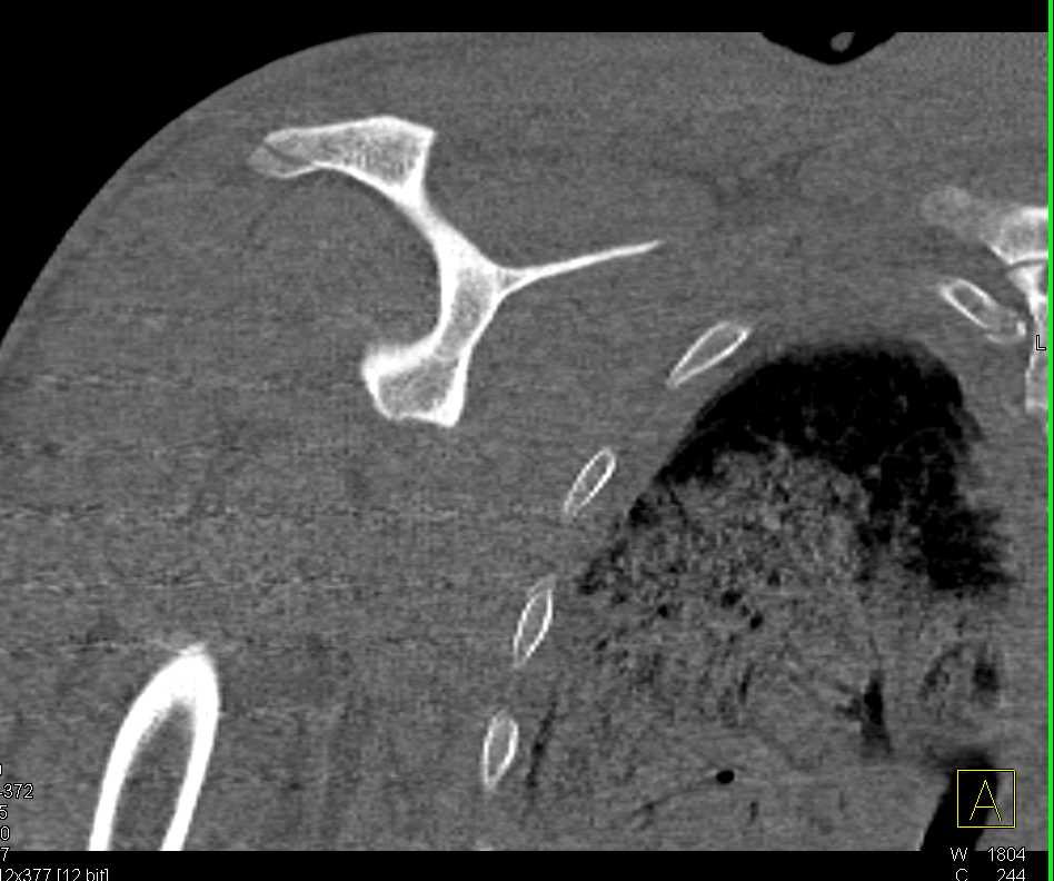 Fracture of the Acromion - Musculoskeletal Case Studies - CTisus CT ...