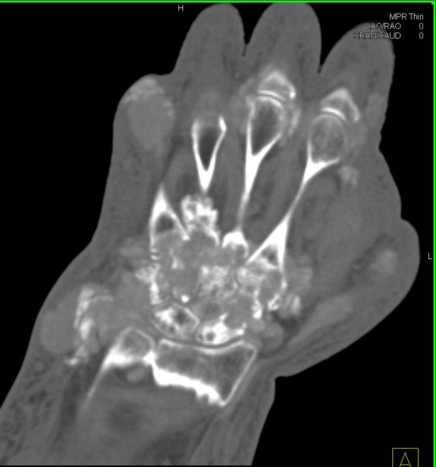 Gout with Dual Energy Technique Shows Extensive Involvement - CTisus CT Scan