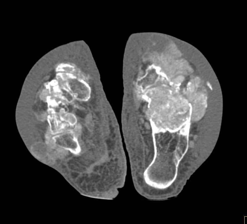 Gout Involves the Hands and Feet - CTisus CT Scan