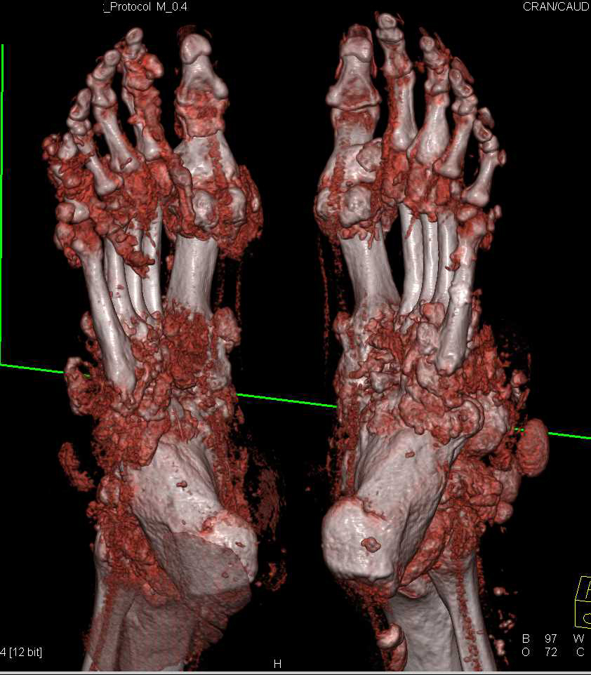 Gout Involves the Hands and Feet - CTisus CT Scan