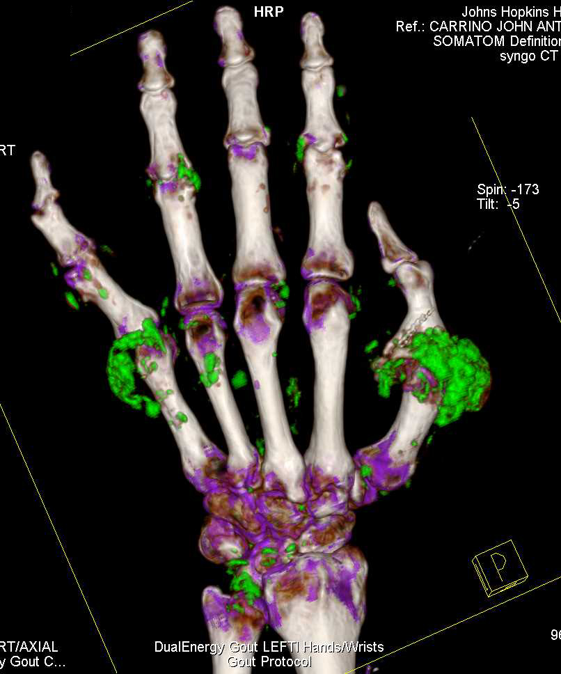 Gout Involves the Hands and Feet - CTisus CT Scan