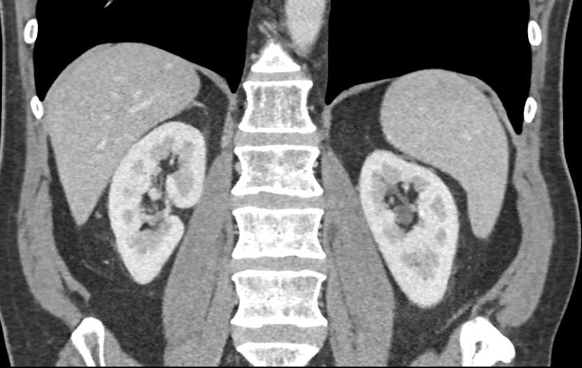 Paget's Disease Left Hemipelvis - CTisus CT Scan