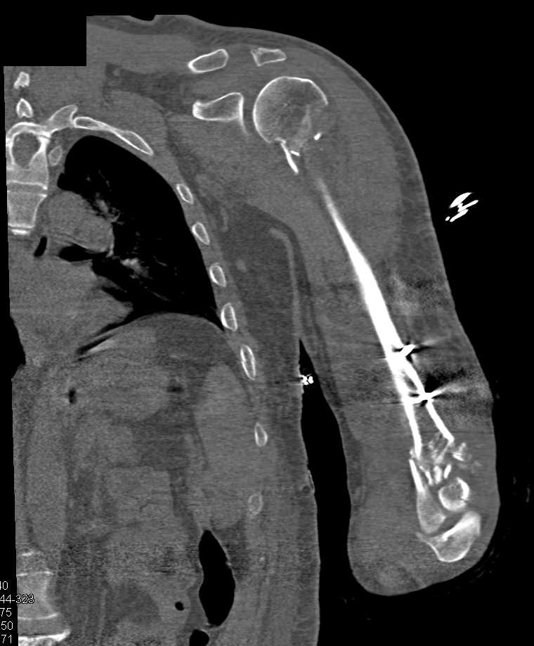 Open Reduction Internal Fixation (ORIF) in 3D for Fractures of the Proximal and Distal Humerus - CTisus CT Scan