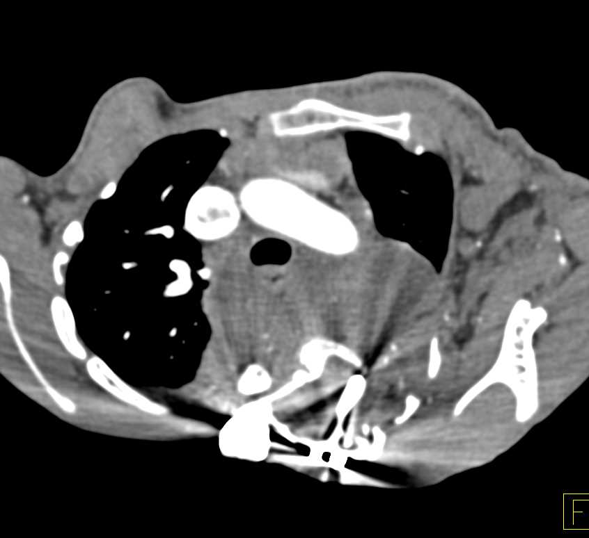 Extensive Neurofibromatosis in the Chest and Abdomen - CTisus CT Scan