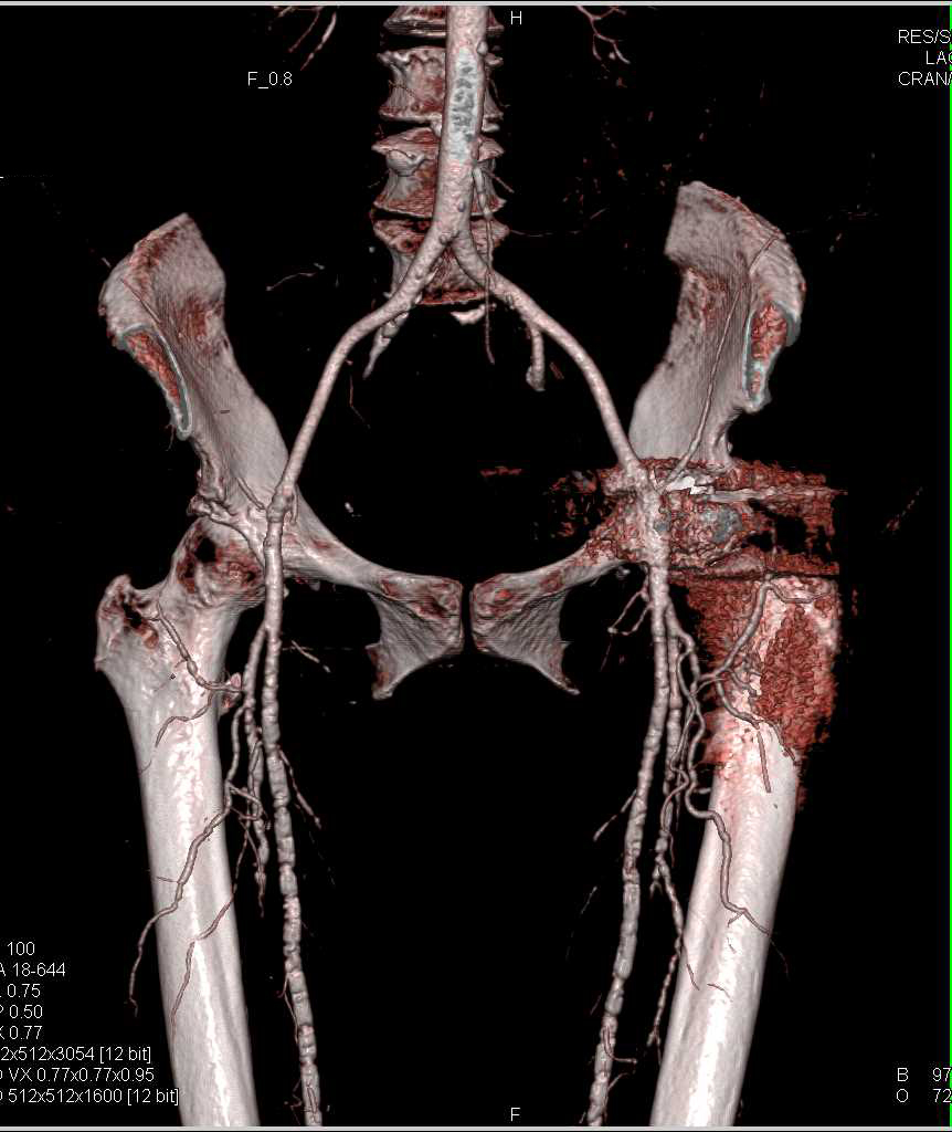 CT Runoff with Pseudo-Occlusion Left Femoral Artery due to Artifact off the Left Total Hip Replacement (THR) - CTisus CT Scan