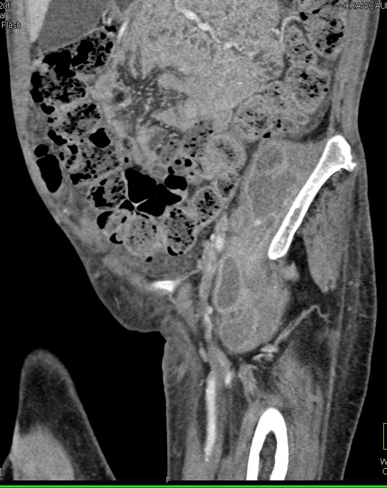 Left Iliopsoas Abscess with Extension to Left Hip Joint - CTisus CT Scan