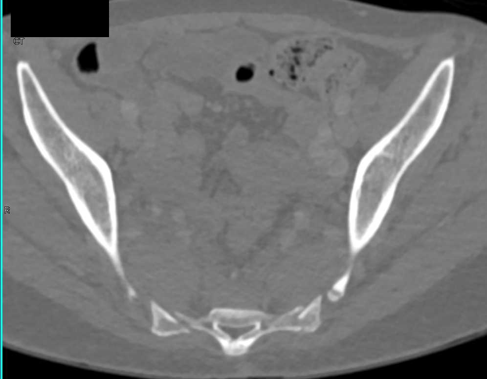 Extramedullary Hematopoiesis - CTisus CT Scan