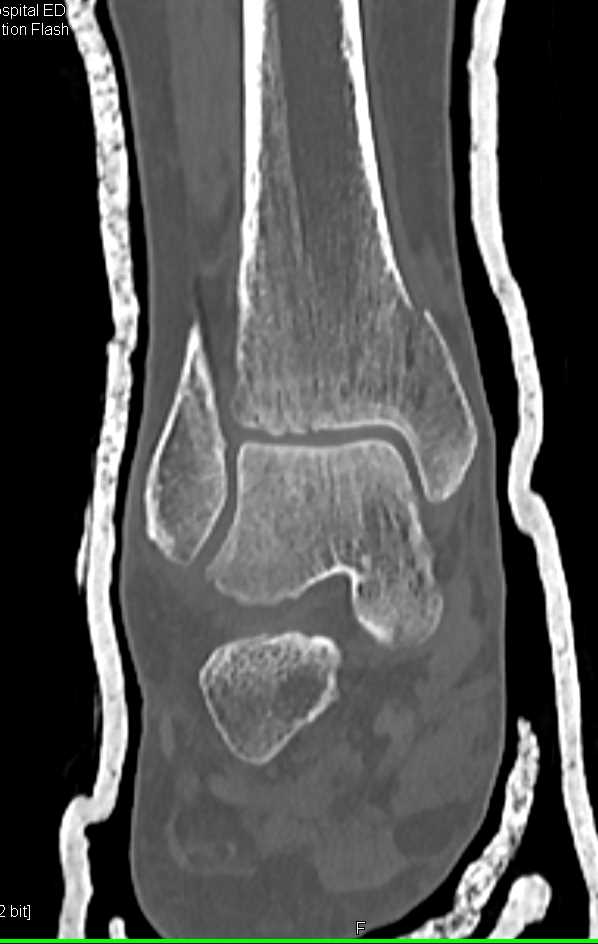 3D Maps of a Tibial Fracture - CTisus CT Scan