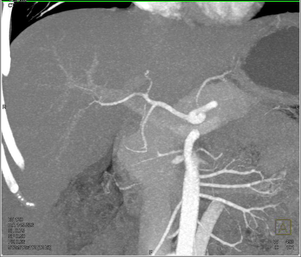 Desmoid Tumor in Rectus Muscle in Patient with FAP (Familial Polyposis Syndrome) - CTisus CT Scan