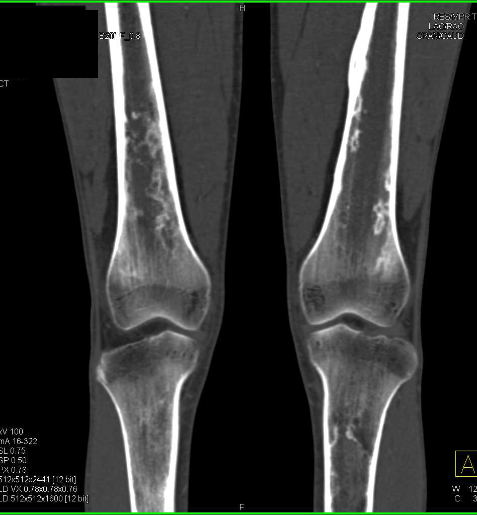 Multiple Bone Infarcts in a Patient with Sickle Cell Disease - CTisus CT Scan