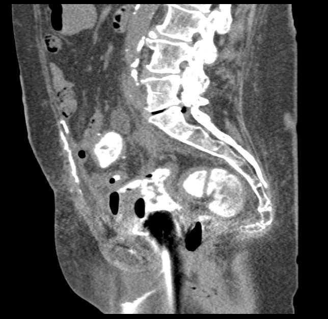 Bilateral Total Hip Placements - CTisus CT Scan