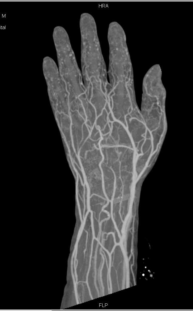 Cellulitis Dorsum of the Hand - CTisus CT Scan