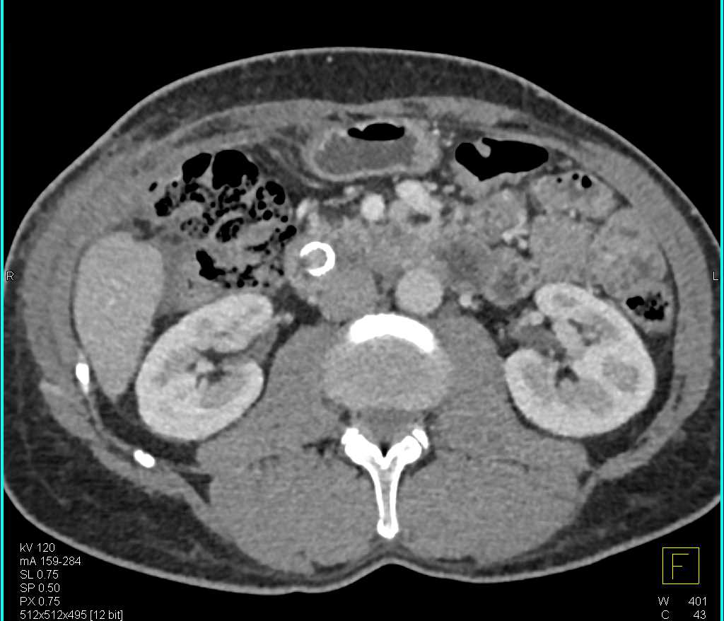 Metastases to the Lower Left Rib - CTisus CT Scan