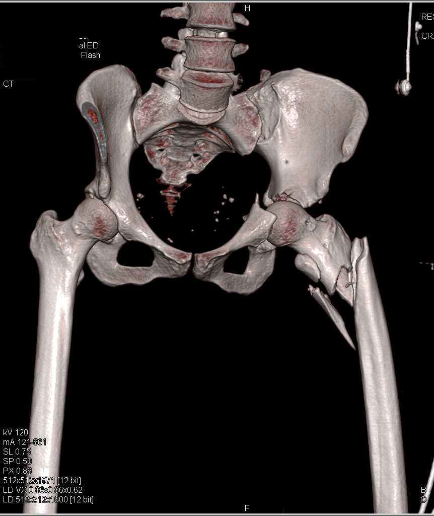 Complex Fracture Involving Left Acetabulum, Femur and Sacroiliac Joint (SI Joint) Seen in 3D - CTisus CT Scan