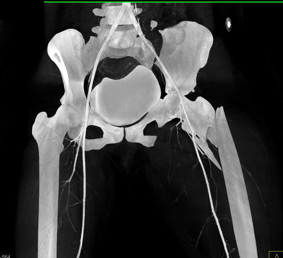 Complex Fracture Involving Left Acetabulum, Femur and Sacroiliac Joint (SI Joint) Seen in 3D With CT Cystogram - CTisus CT Scan