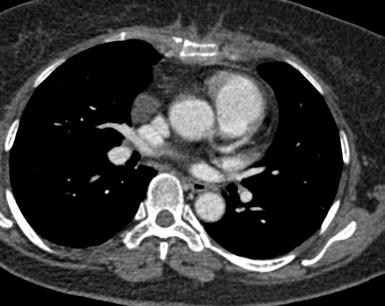 Lymphoma with Tumor Infiltration of the Sternum - CTisus CT Scan