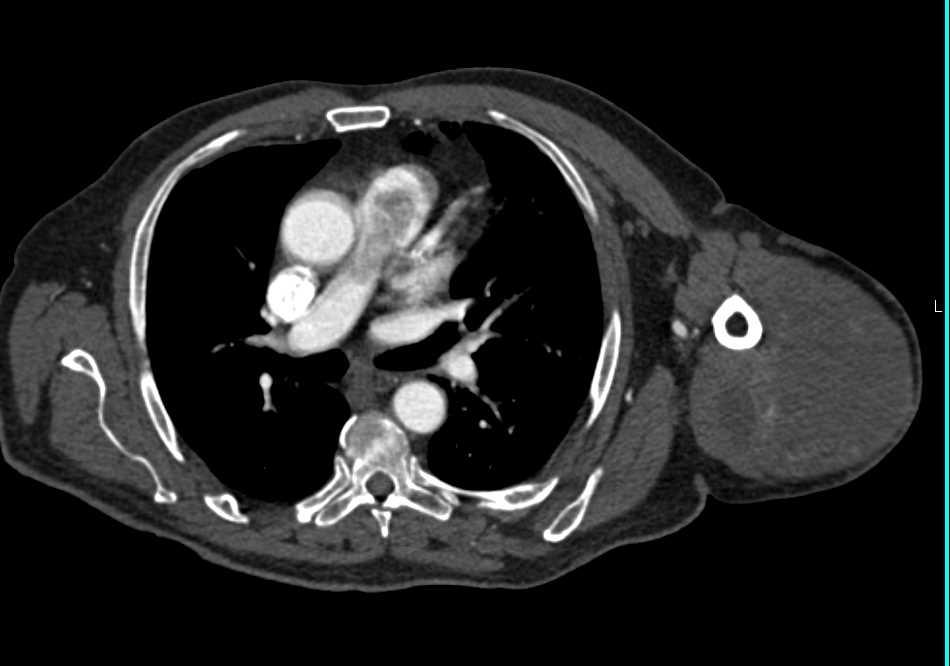 Sarcoma Left Shoulder with Necrosis - CTisus CT Scan