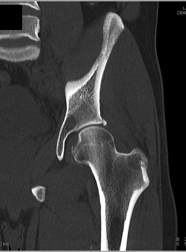 Subtle Fracture Femur near Fovea - Musculoskeletal Case Studies ...