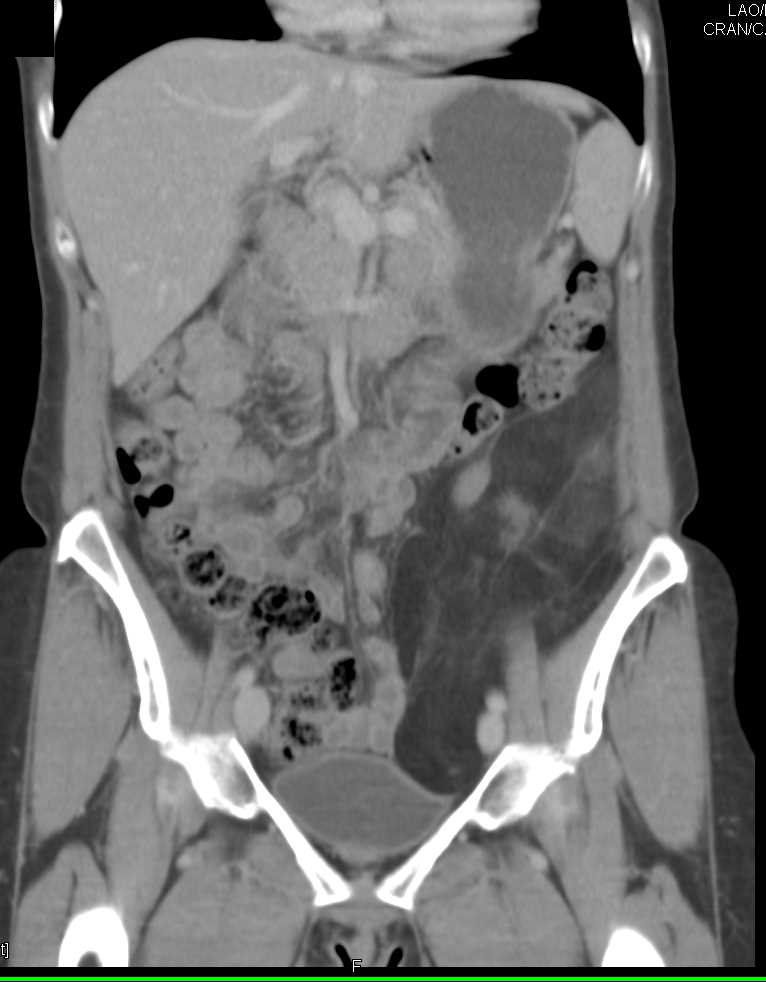 Retroperitoneal Liposarcoma in Left Lower Quadrant - CTisus CT Scan