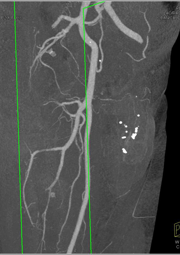 Stabbing Left Thigh with Active Bleed - CTisus CT Scan