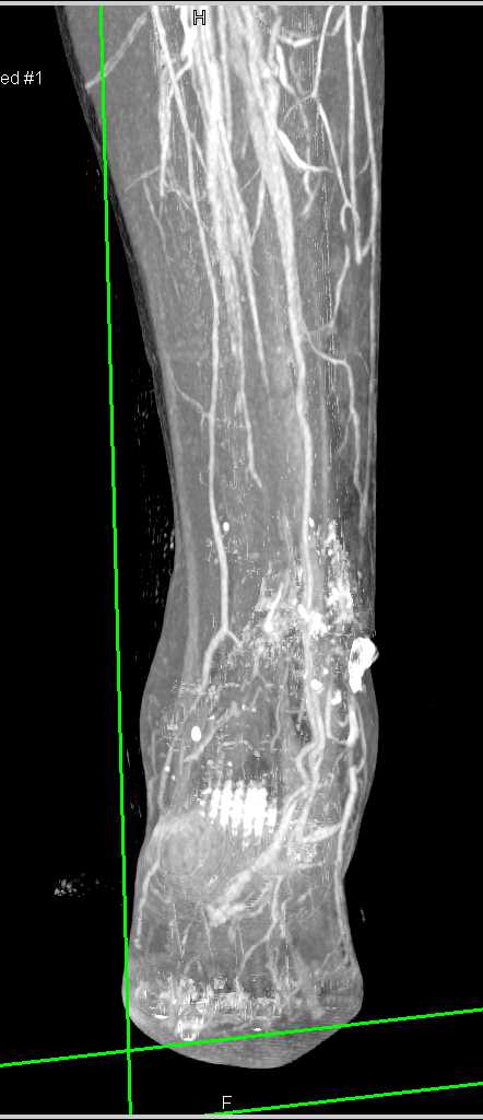 Complex Fractures Distal Tibia and Fibula with Ulcerations - CTisus CT Scan