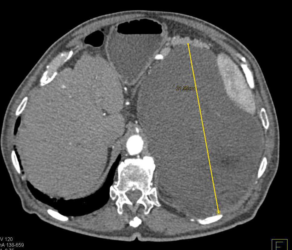 Retroperitoneal Liposarcoma in Left Lower Quadrant - CTisus CT Scan