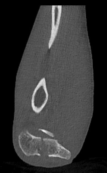 Humerus Fracture in Proximal and Distal Humerus in 3D - CTisus CT Scan