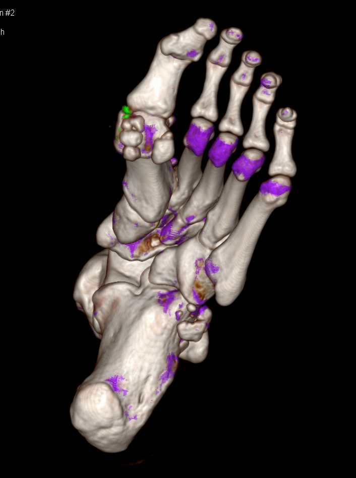 Dual Energy Diagnosis of Gout - CTisus CT Scan