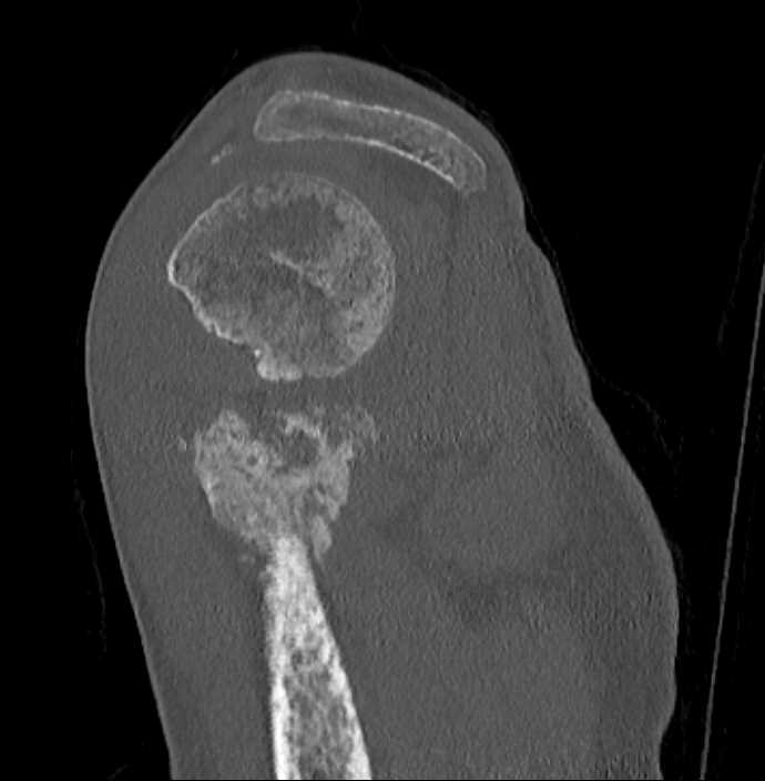 Humerus Fracture With Callous Formation but Non-union ...