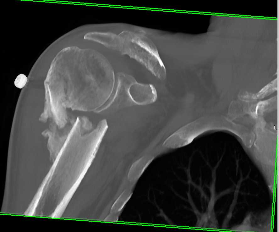 Humerus Fracture With Callous Formation but Non-union - CTisus CT Scan