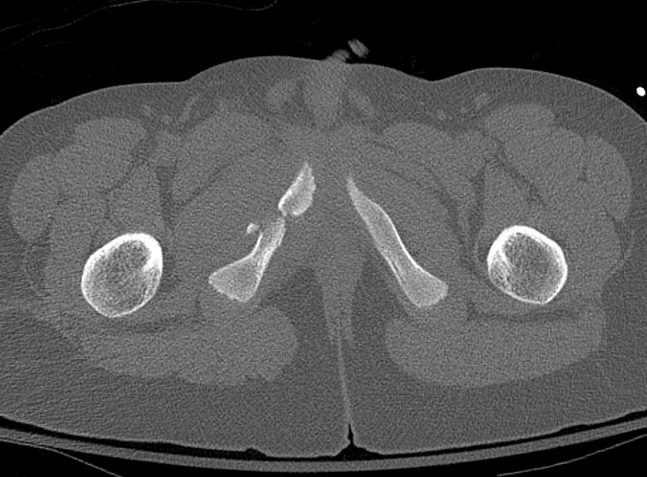 Right Pubis Fractures with Diastasis ay Symphysis Pubis - CTisus CT Scan