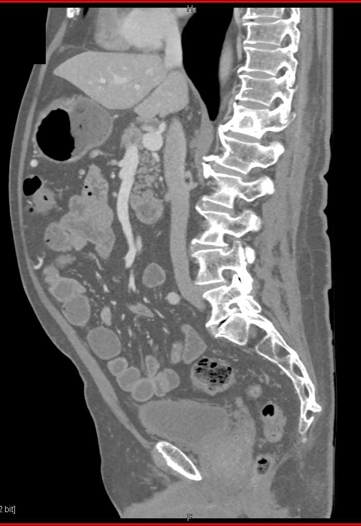 Bone Metastases from Pancreatic Adenocarcinoma - CTisus CT Scan