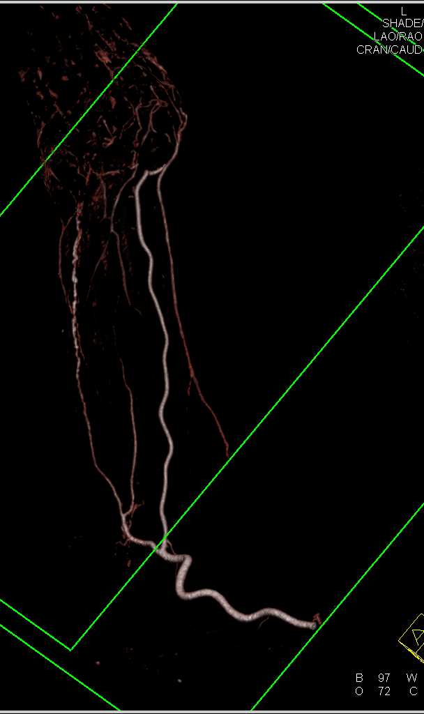 Beading of the Ulnar Artery Best Seen on Bone Removal - CTisus CT Scan