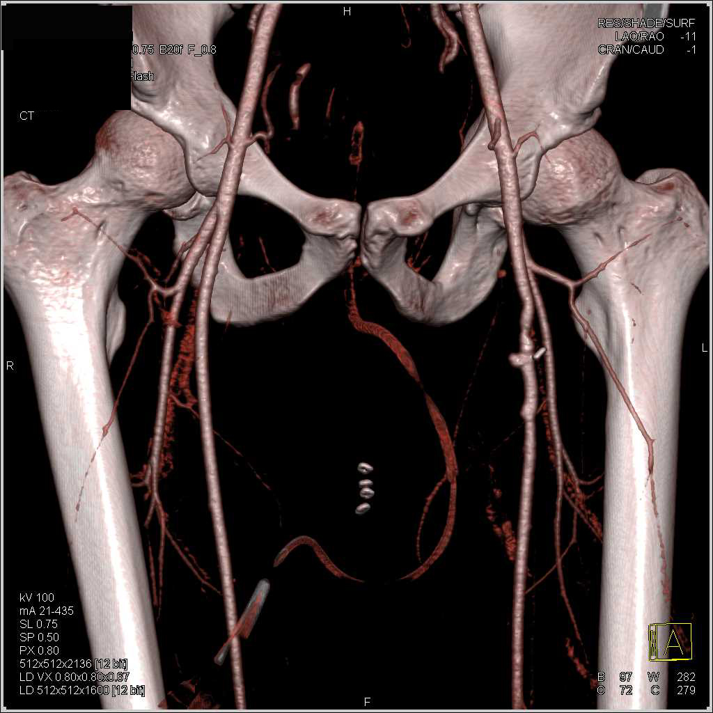 Vasculitis with Inflammation in Muscle - CTisus CT Scan