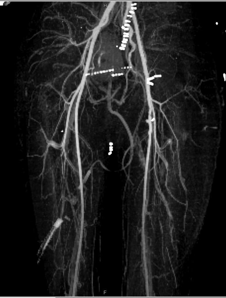 Vasculitis with Inflammation in Muscle and Abscesses - CTisus CT Scan