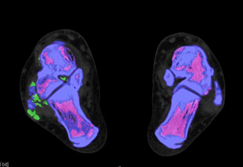 Gout Shown on Dual Energy CT - CTisus CT Scan