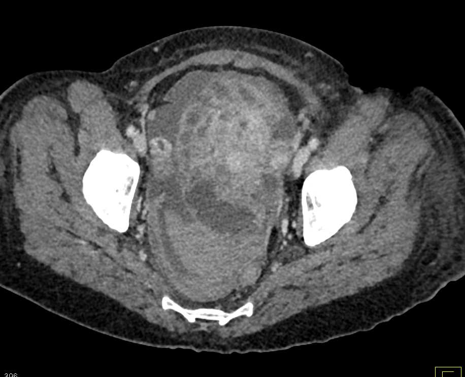 Hematoma Right Thigh - CTisus CT Scan