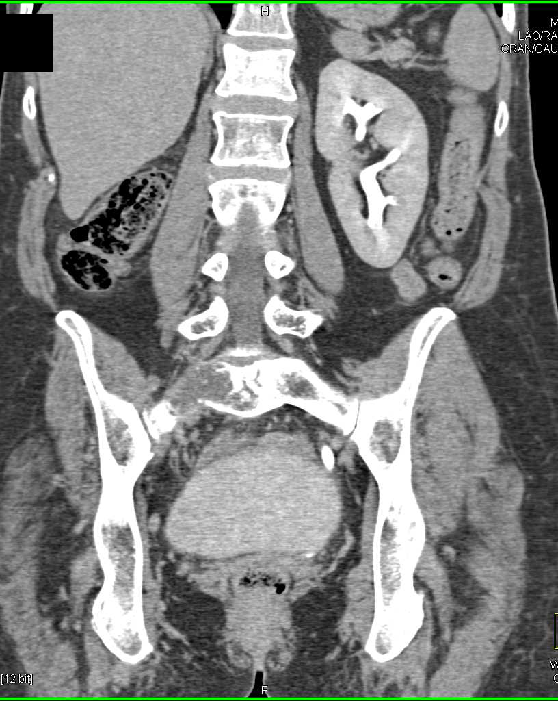 Recurrent Renal Cell Carcinoma with Sacral Metastases - CTisus CT Scan