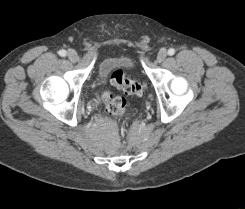 Sacral Chordoma - CTisus CT Scan