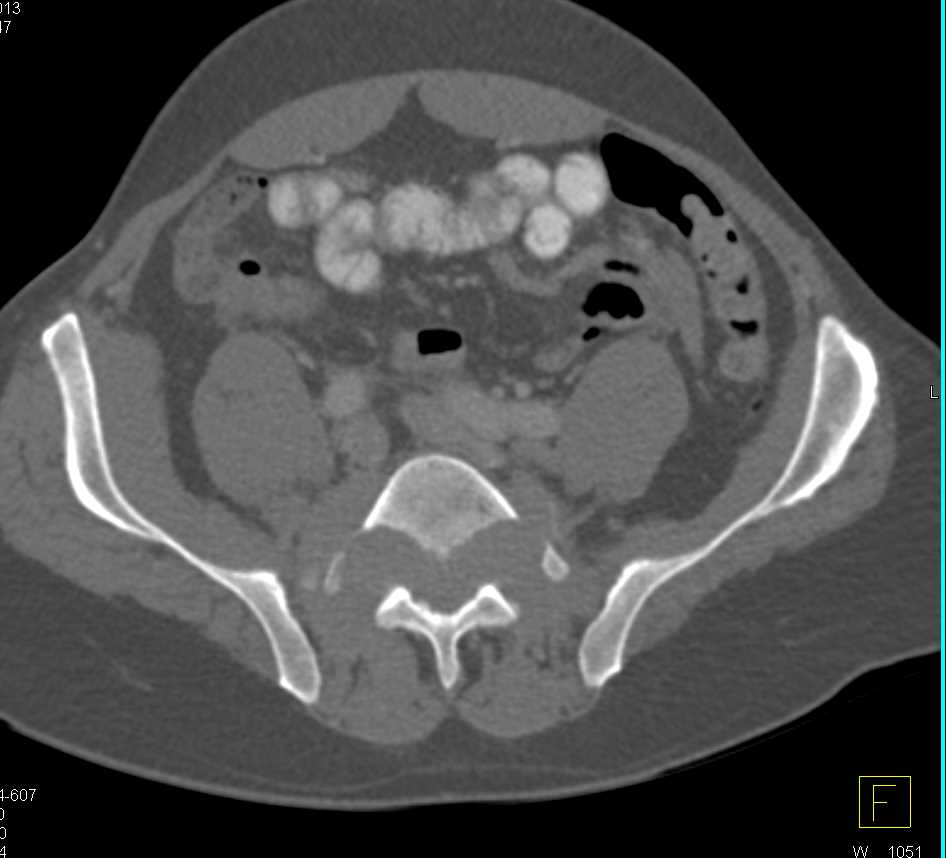 Sacral Chordoma - CTisus CT Scan