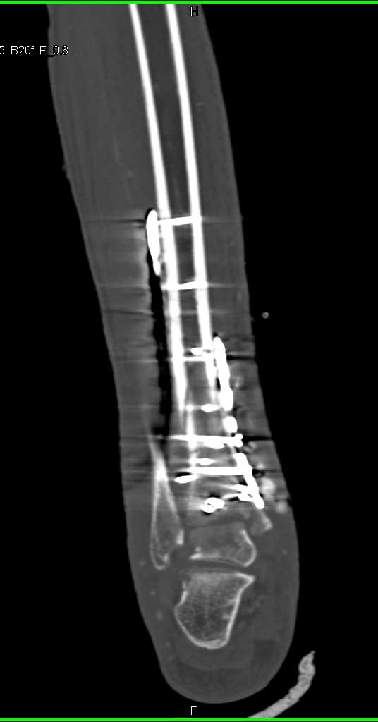 Hardware Repair of Tibial Fracture - CTisus CT Scan