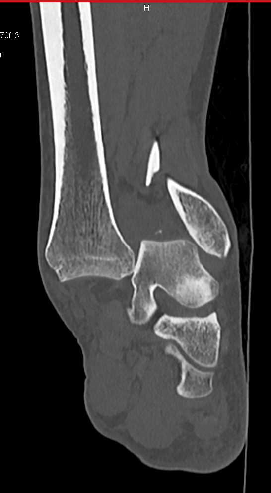 Dislocated/Fractured Ankle While Complaint Was Shoulder Pain - CTisus CT Scan