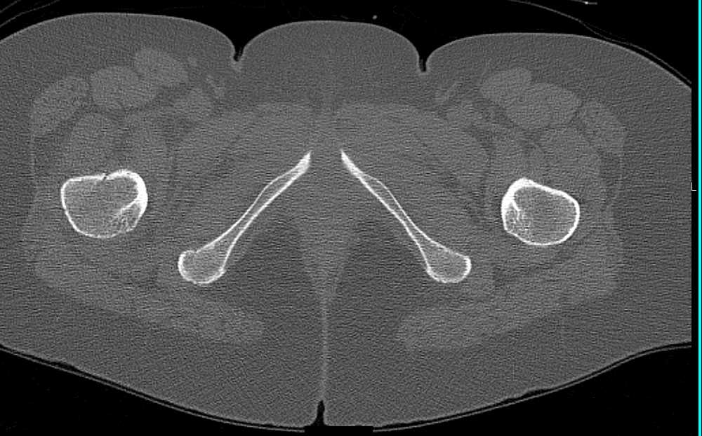 Subtle Right Femur Fracture - CTisus CT Scan