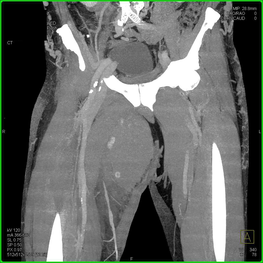 Large Hematoma Left Thigh Without Bleed - CTisus CT Scan