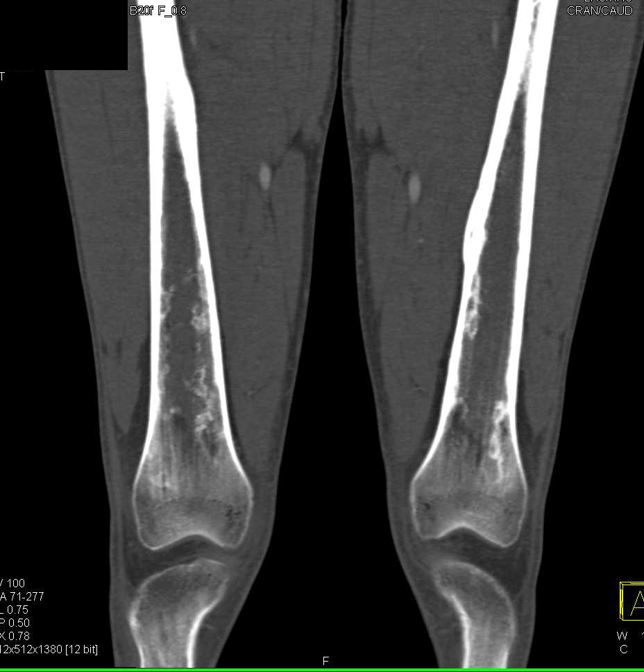 Incidental Bone Infarcts on CTA Runoff Study - CTisus CT Scan